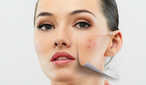 how-to-get-rid-of-acne-fast-without-buying-anything